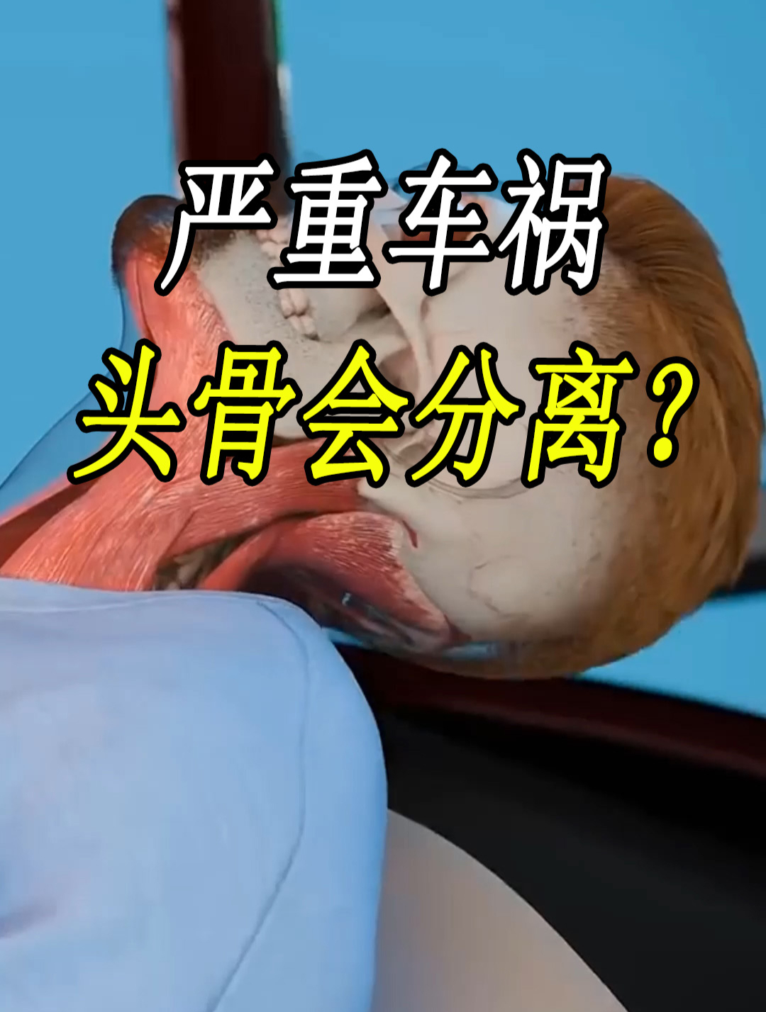 如果发生严重车祸,猛烈的撞击,为什么会使头骨与脊柱分离?