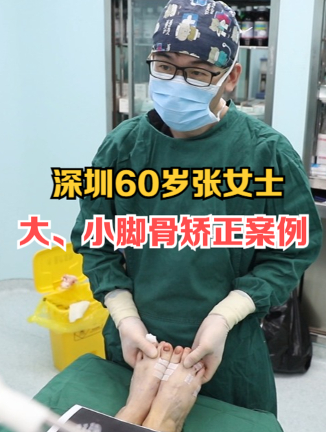 真实案例:深圳60岁张女士大小脚骨,锤状趾综合矫正,手术3小时