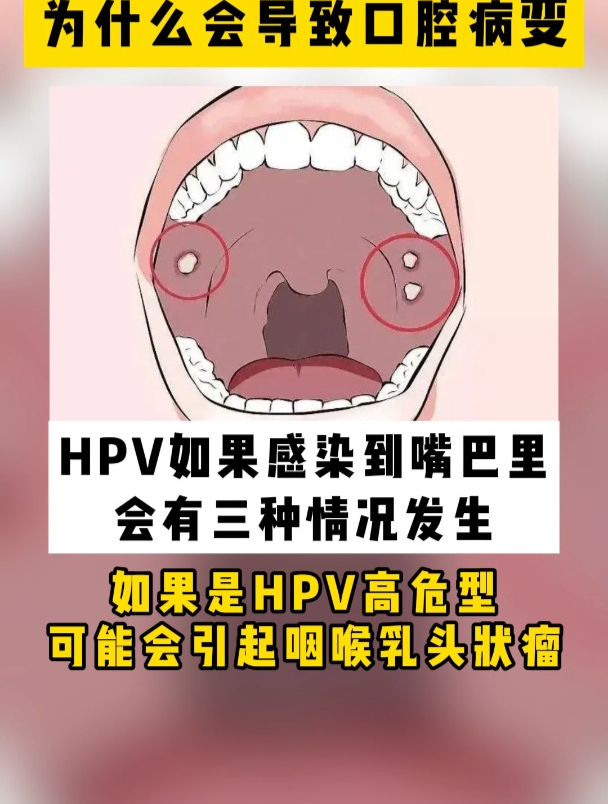 警惕HPV感染,别让嘴巴长出“菜花”!