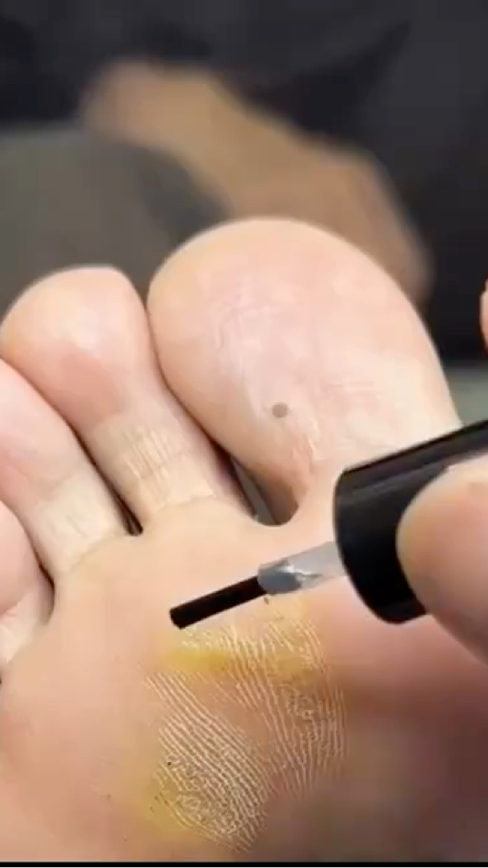 鸡眼处理修复的小妙招