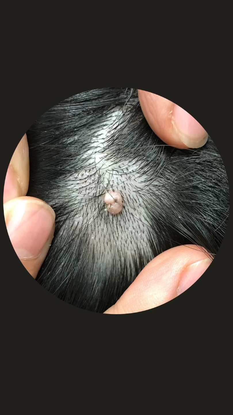 不同模样的皮内痣(肉痣)