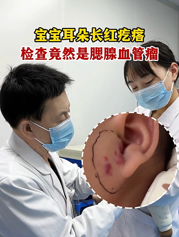 宝宝耳朵长红疙瘩,检查竟然是腮腺血管瘤