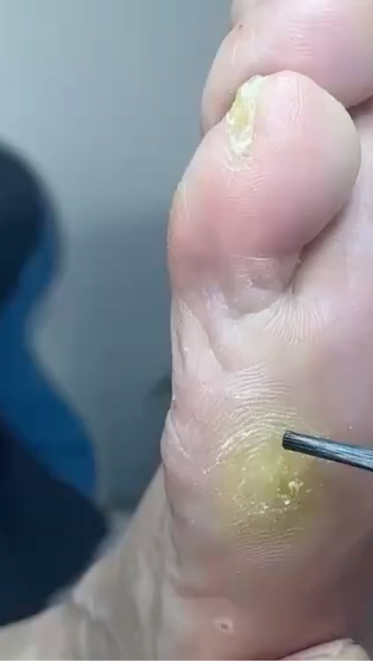 鸡眼处理修复的小妙招