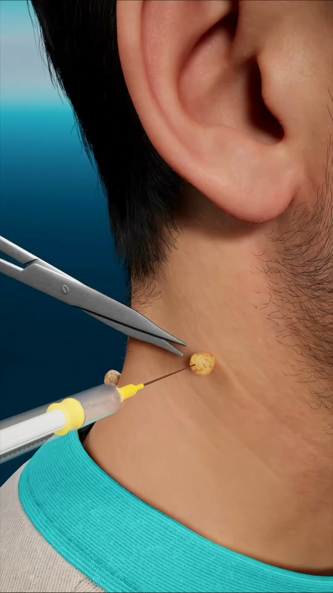 身上的皮赘如何去除