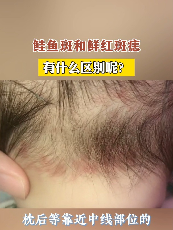 鲑鱼斑和鲜红斑痣,有什么区别呢?