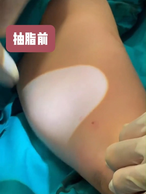 抽脂前后对比 效果立竿见影