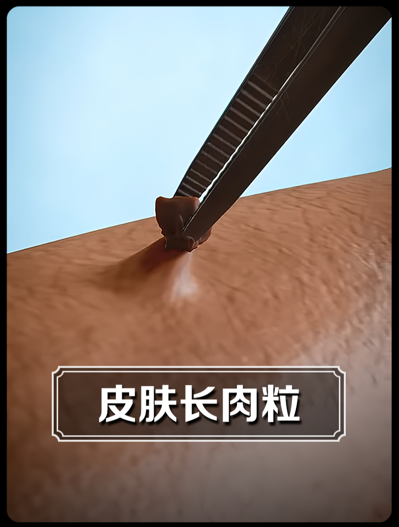 皮肤上的小肉粒和疣,该如何去除呢?