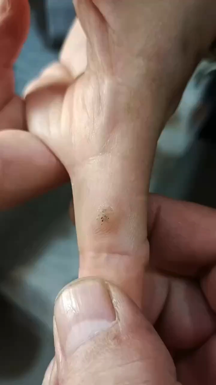 手指长了刺瘊子它不是鸡眼