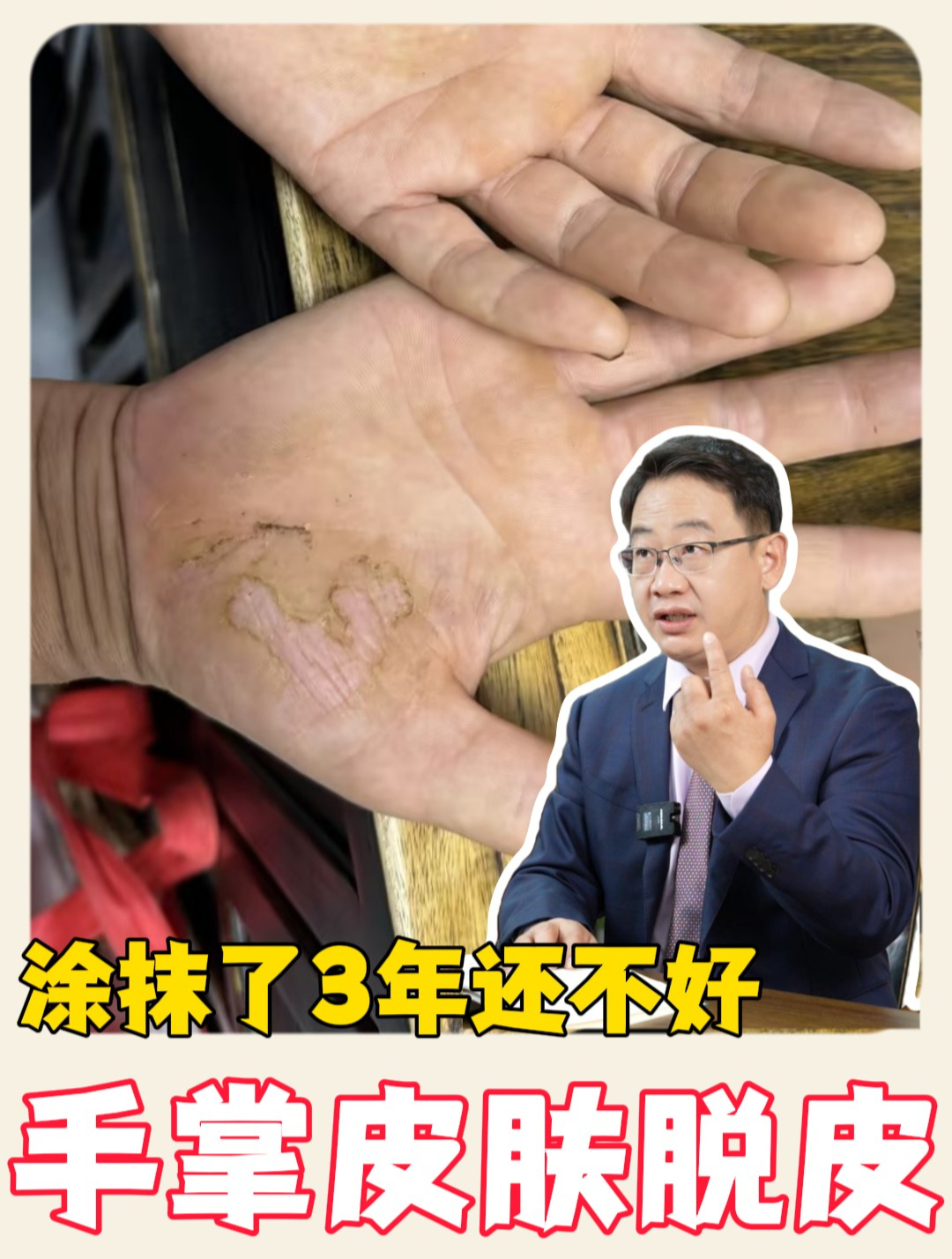 手掌皮肤开裂,涂抹3年了都不好,怎么办?