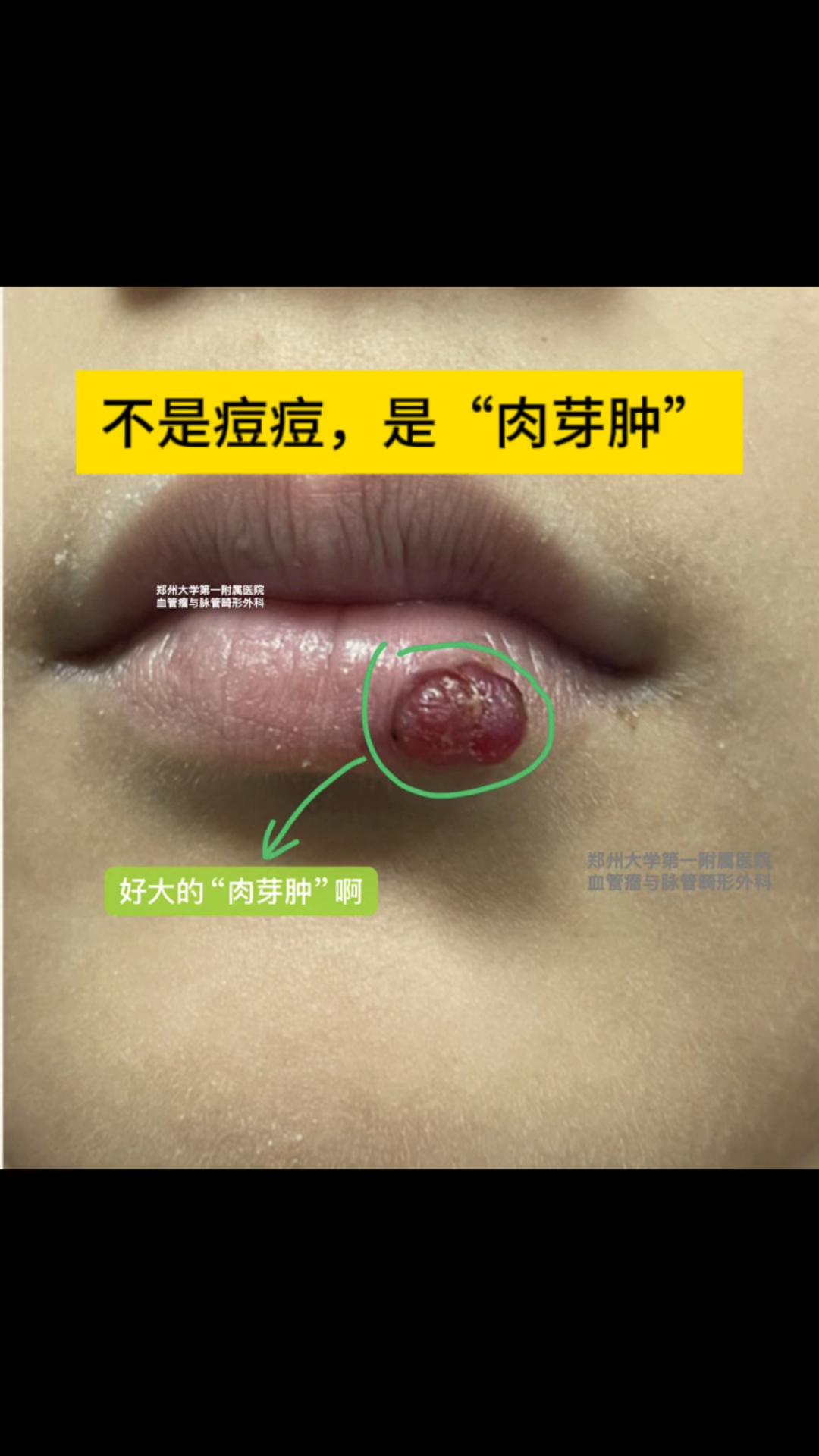 “肉芽肿”无痕治疗