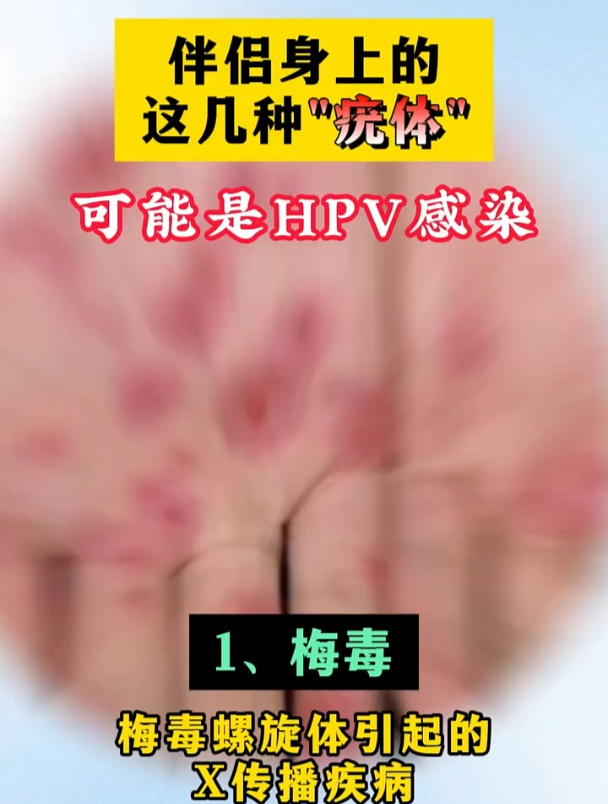 伴侣身上的这几种“疣体”,可能是HPV感染!