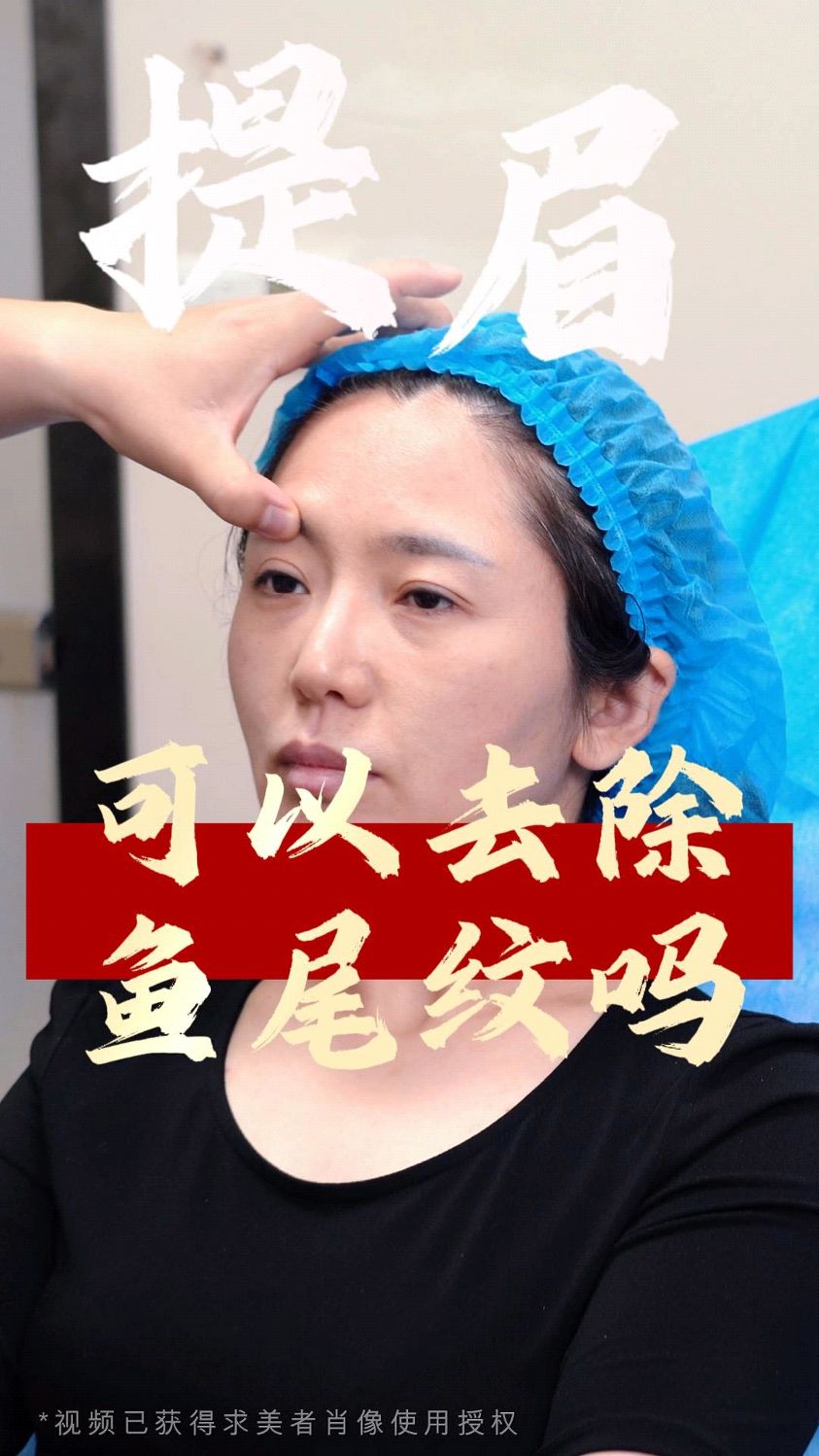 提眉可以去除鱼尾纹吗?