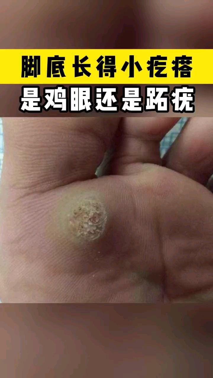 脚底长的小疙瘩是鸡眼还是瘊子呢?