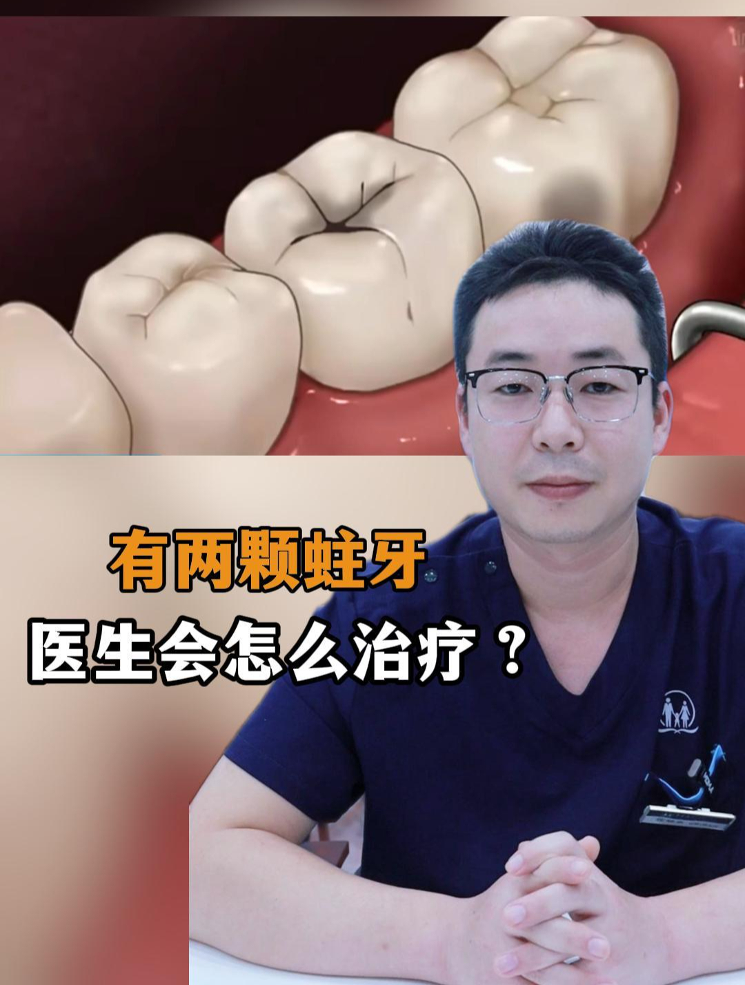 有两颗蛀牙,医生会怎么治疗?