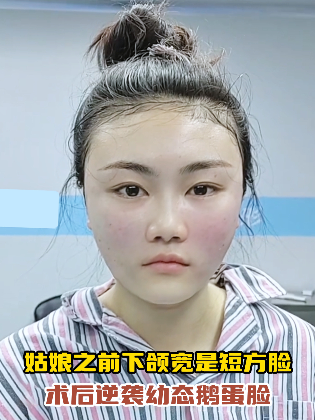 姑娘之前下颌宽苹果肌肥厚是短方脸,经过沙院调整变成鹅蛋脸了