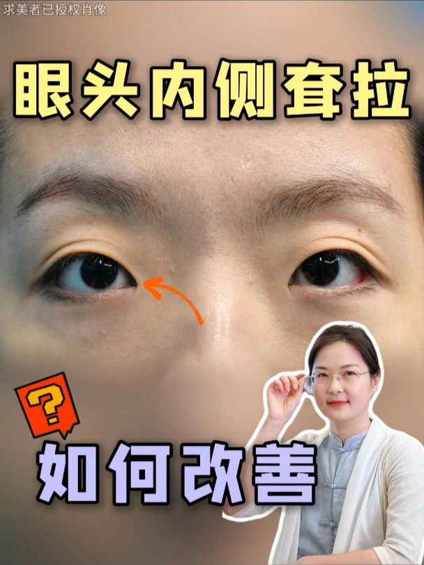 眼头内侧微下垂,也可能是肌无力的锅