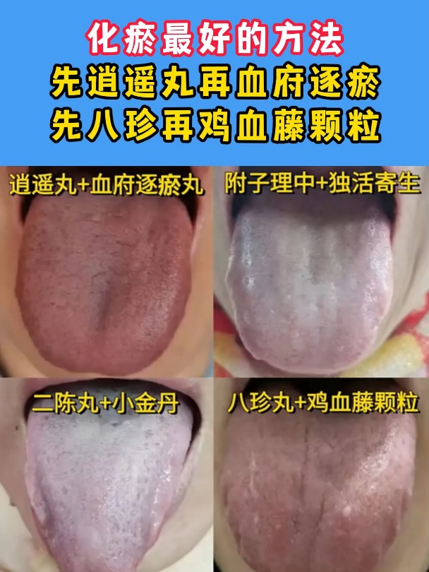 化瘀最好的方法,先逍遥丸再血府逐瘀,先八珍再鸡血藤颗粒!