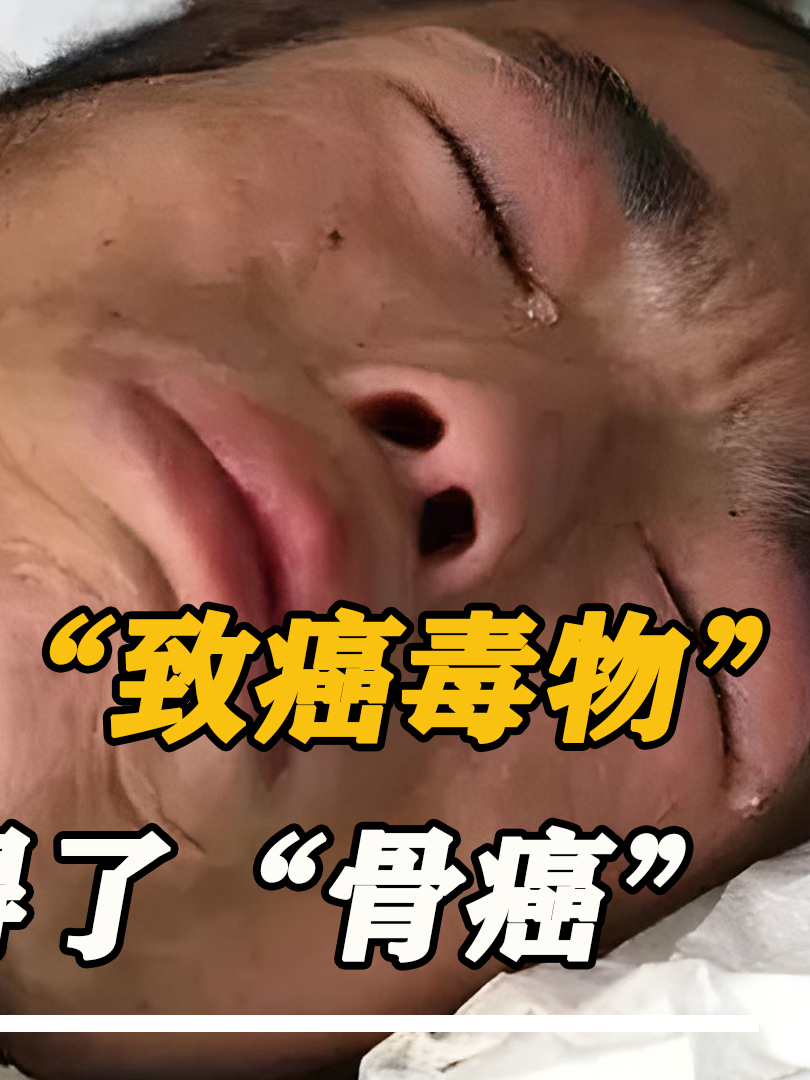 驴肉火烧成“致癌毒物”,河北3兄弟得了“骨癌”,竟然是槽头肉