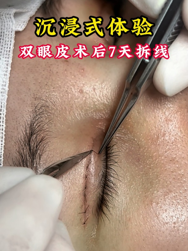 沉浸式体验,双眼皮术后7天拆线!