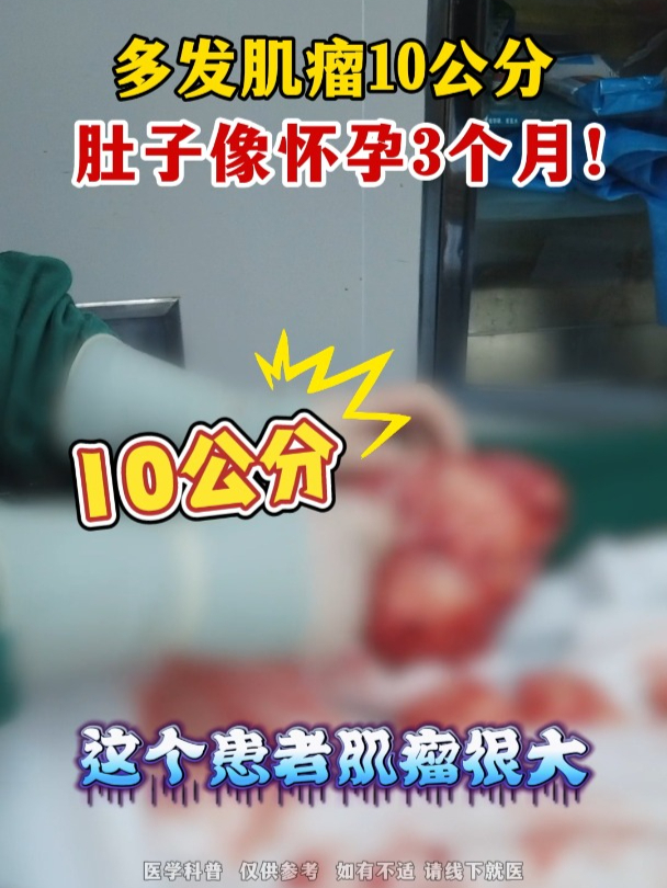 多发肌瘤10公分,肚子像怀孕3个月!