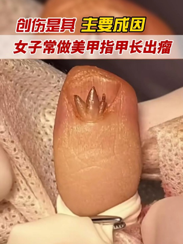 女子隔三岔五做美甲,结果指甲上长了个肉瘤,形状还挺奇特!