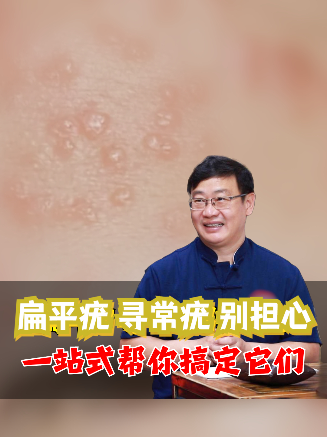 扁平疣、寻常疣别担心,一站式帮你搞定