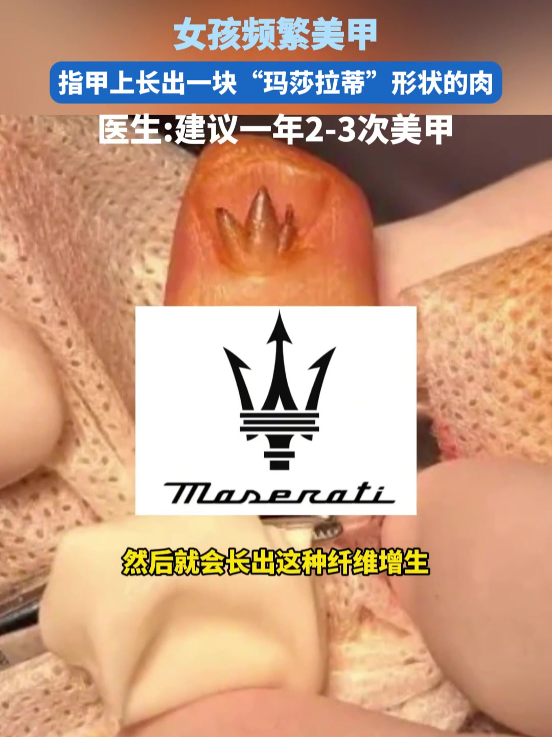 女孩频繁美甲指甲上长出一块“玛莎拉蒂”形状的肉!