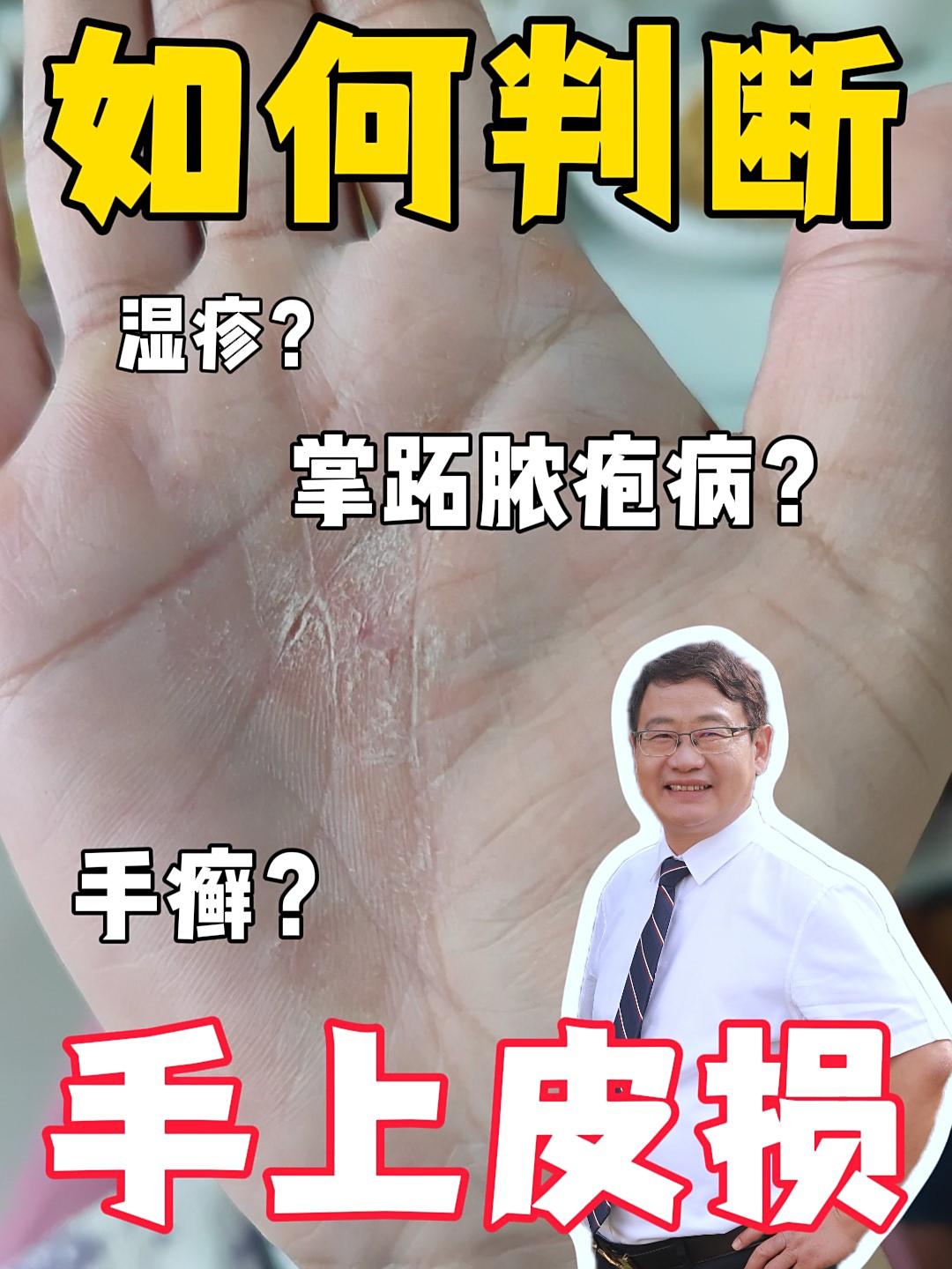 如何知道手上的皮损是手癣?湿疹?还是掌跖脓疱病?