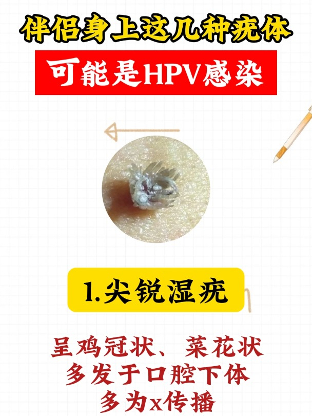 伴侣身上这几种疣体,可能是HPV感染