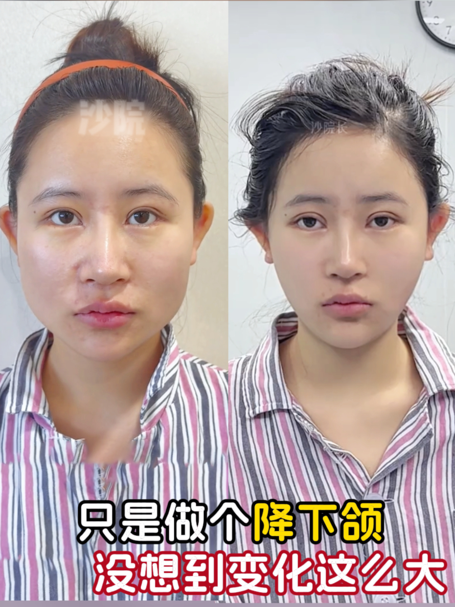 姑娘因为下颌宽导致脸又方又大,于是来微调下颌,术后逆袭鹅蛋脸