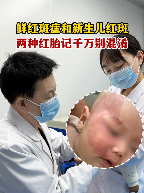 鲜红斑痣和新生儿红斑,两种红胎记千万别混淆