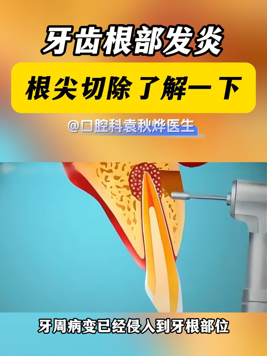 牙齿根部发炎了,根尖切除术了解一下