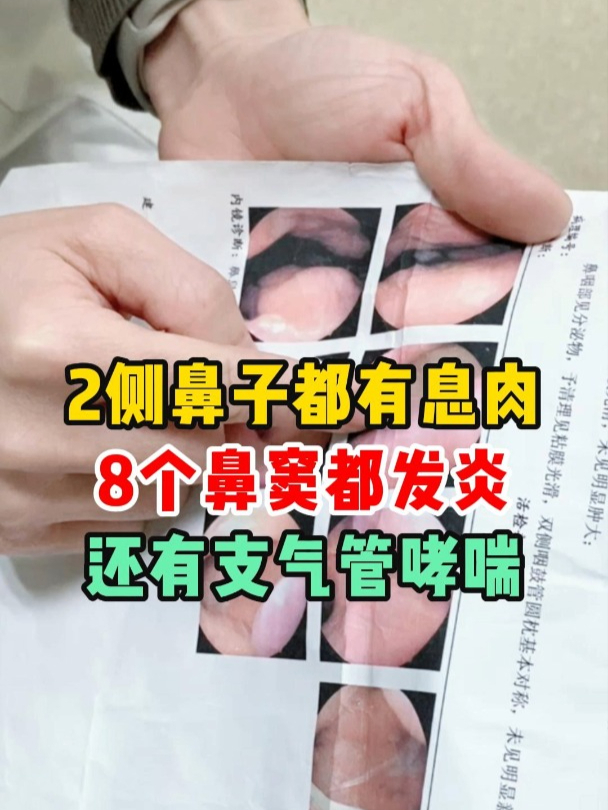 2侧鼻子有息肉,8个鼻窦都发炎,还有支气管哮喘,病情复杂怎么办