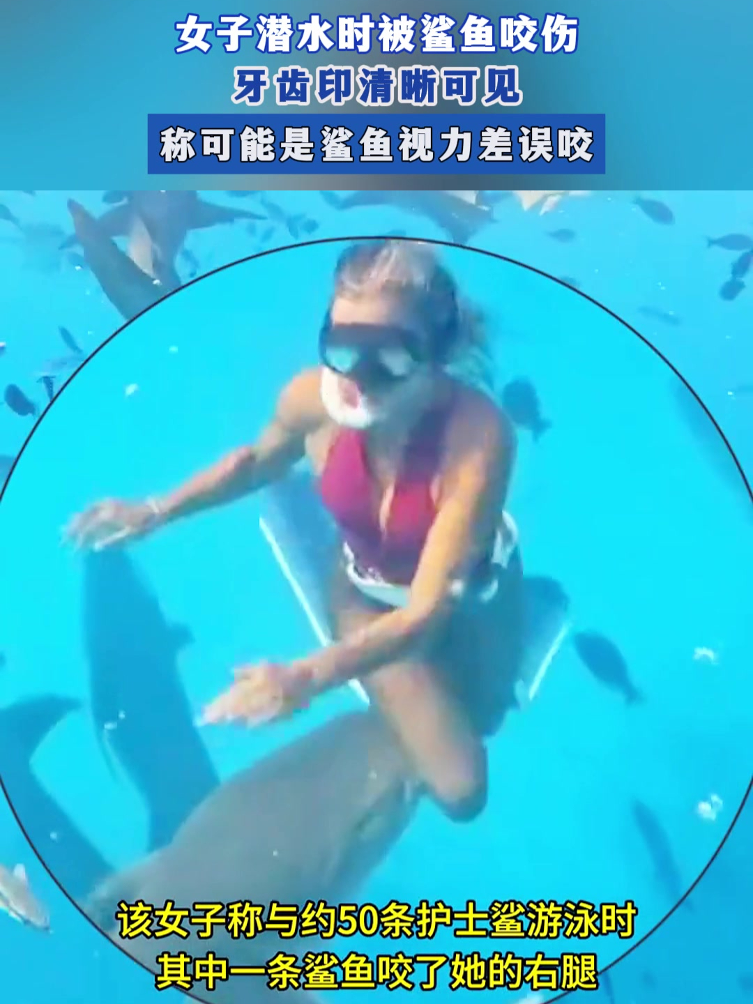 女子潜水时被鲨鱼咬伤,牙齿印清晰可见,称可能是鲨鱼视力差误咬