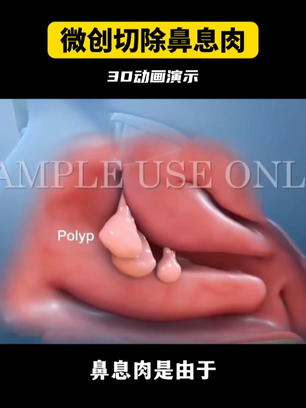 3D动画演示,微创手术切除鼻息肉