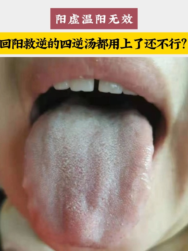 阳虚温阳无效,回阳救逆的四逆汤都用上了还不行