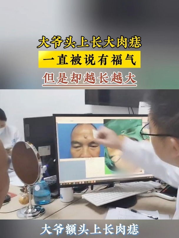 大爷头上长大肉痣,一直被说有福气