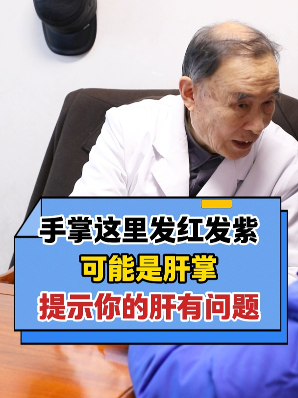 手掌这里发红发紫,可能是肝掌,提示你的肝有问题!