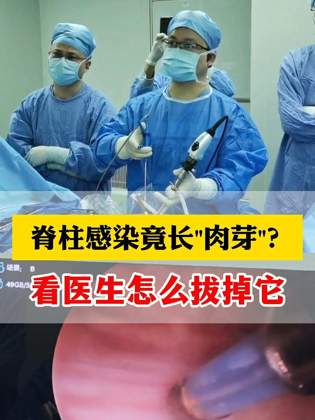 脊柱感染竟长“肉芽”?看医生怎么拔掉它