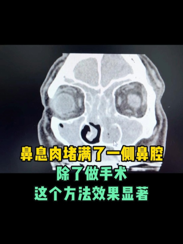 鼻息肉堵满了一侧鼻腔,除了做手术,这个方法效果显著