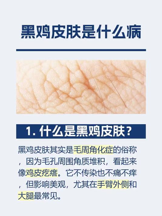 黑鸡皮肤是什么病