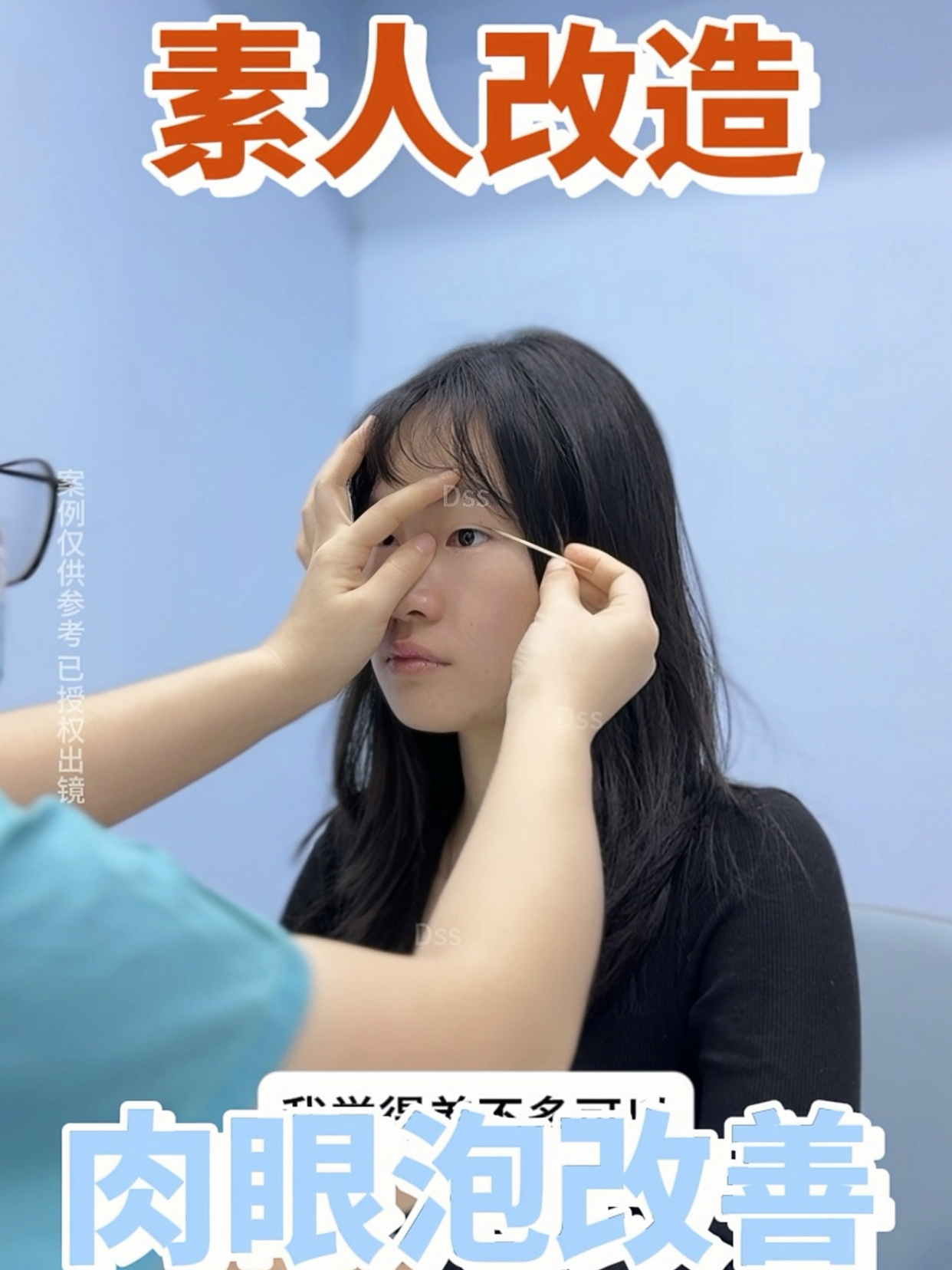 素人改造肉眼泡改善