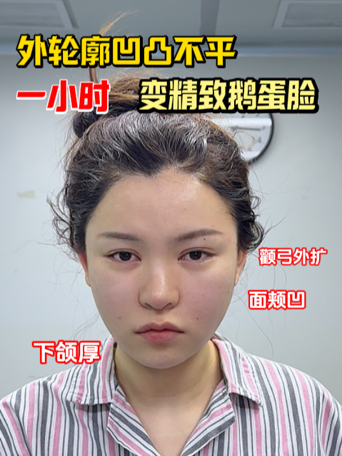 高颧骨宽下颌,不动骨一个小时变精致鹅蛋脸!