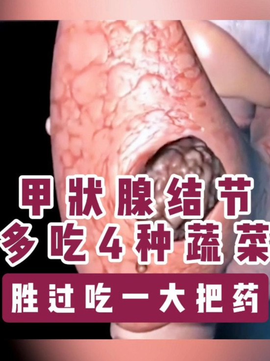 甲状腺结节多吃4种蔬菜,胜过吃一大把药