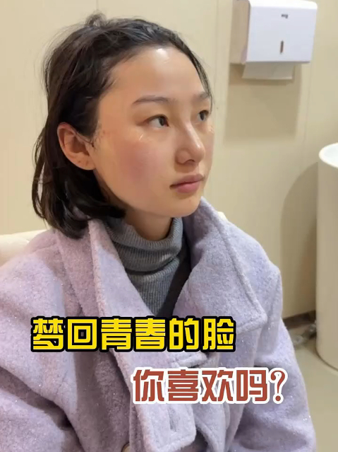 术后第二天的样子,轮廓线流畅,脸型接近鹅蛋形,你觉得值吗?