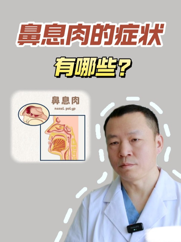 鼻息肉症状大揭秘,让你早发现早治疗!