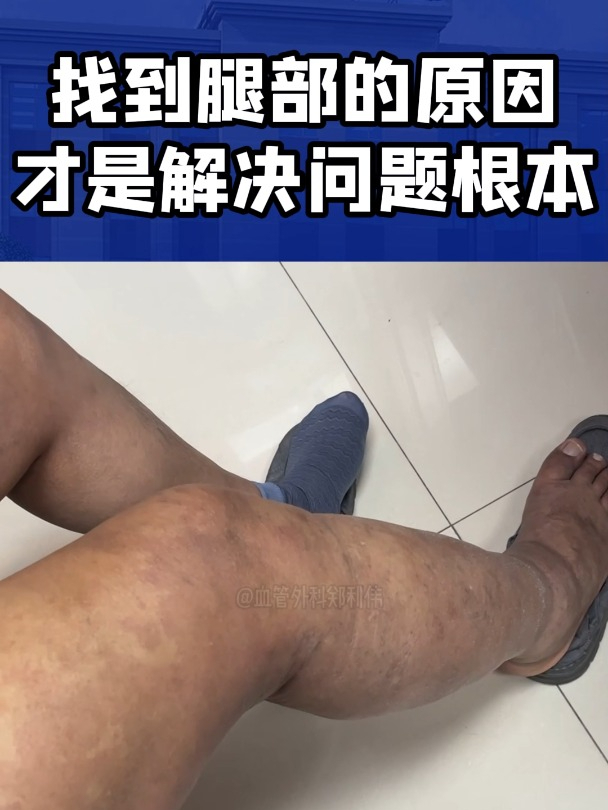 找到腿部的原因,才是解决问题根本