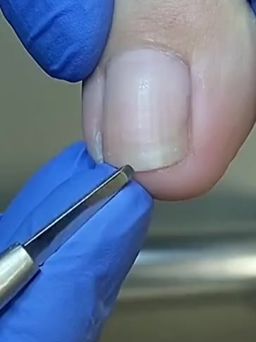 指甲嵌肉里,晚上都不能盖被子了