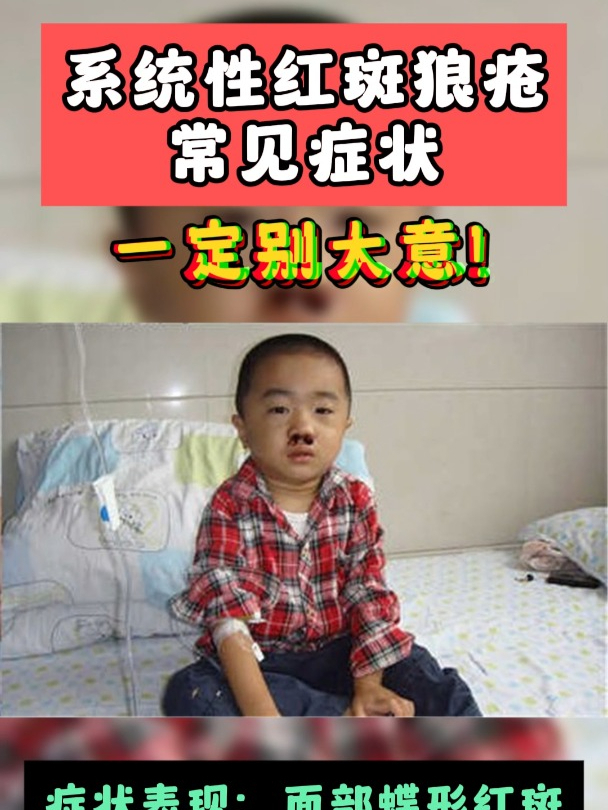 系统性红斑狼疮常见症状,一定别大意!