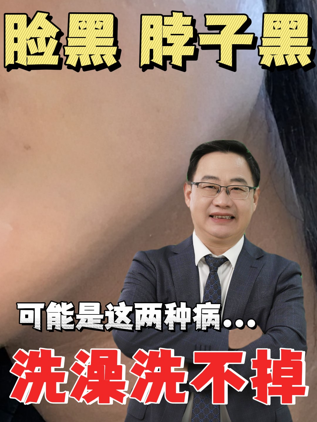 脸黑脖子黑,洗澡洗不掉,可能是黑变病